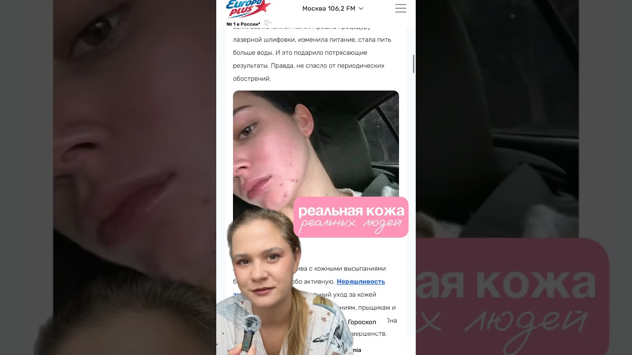 1 часть в профиле 🙇🏼‍♀️ П знаменитости акне селебрити