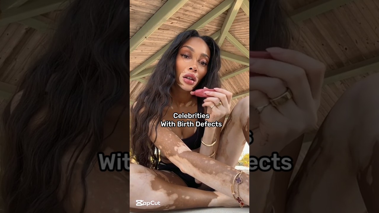 Celebrities with birth defects