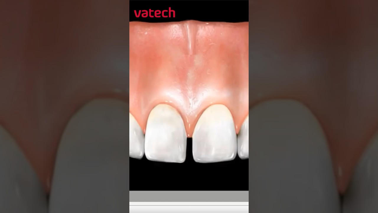 Как убрать щель между зубами? shorts стоматология vatech