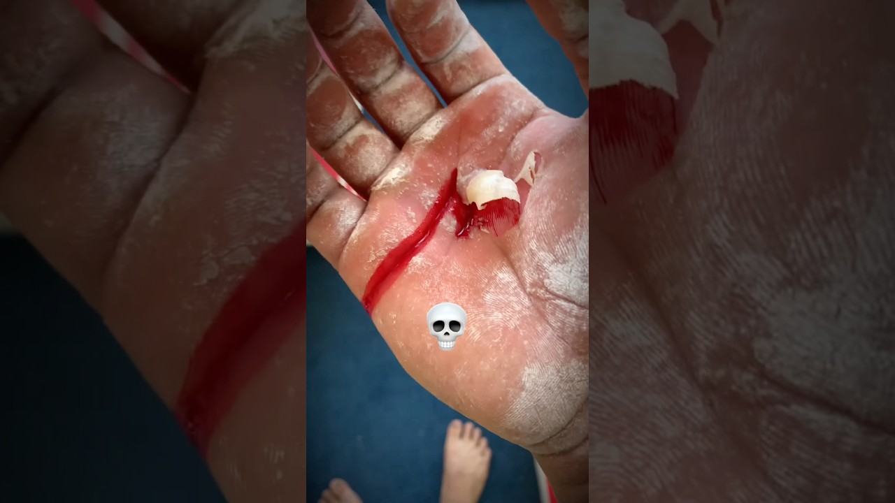 Мозоли это каждого боль спортсмена 💀😢 sports workout trending